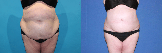 excess skin reduction surgery before and after New Zealand - Dr Mark Gittos Best Plastic Surgeon NZ
