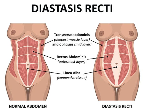 diastasis recti surgery