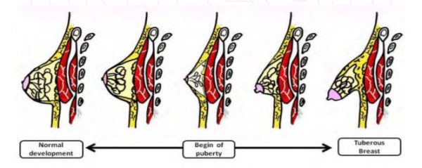 puffy nipples - pointy nipples - pointy tits tuberous breasts New Zealand - Dr Mark Gittos Best Plastic Surgeon NZ