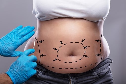 tummy tuck