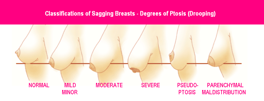 hanging tits - perky nipples New Zealand - CHART for Saggy Tits, Sagging Breasts, Torpedo Tits, Droopy Tits and Droopy Breast Chart - Dr Mark Gittos Best Breast Surgeon New Zealand Auckland