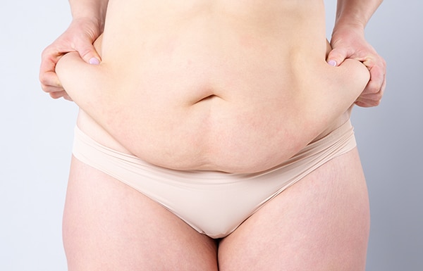 Fleur De Lis Abdominoplasty NZ - Dr Mark Gittos Plastic Surgeon