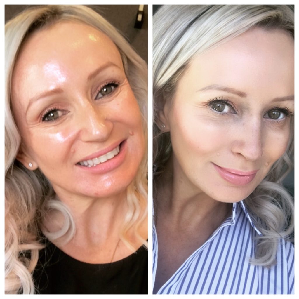 Rhinoplasty Before and After Photos