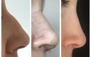 Rhinoplasty Surgery Auckland NZ - Nose Job Auckland - Dr Mark Gittos Best Plastic Surgeon NZ