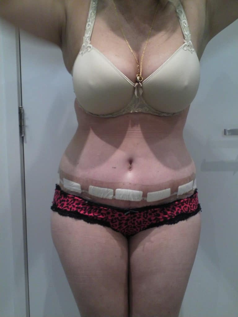 Tummy Tuck Before and After Photos