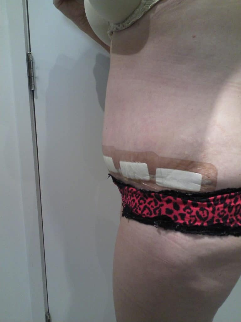 Tummy Tuck Before and After Photos