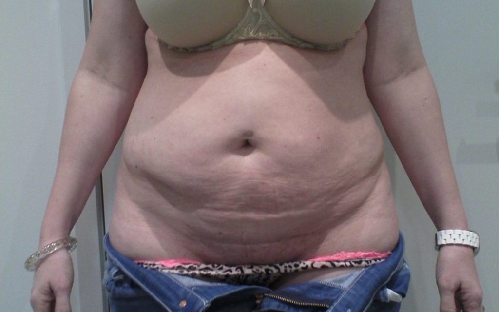 Tummy Tuck Before and After Photos NZ