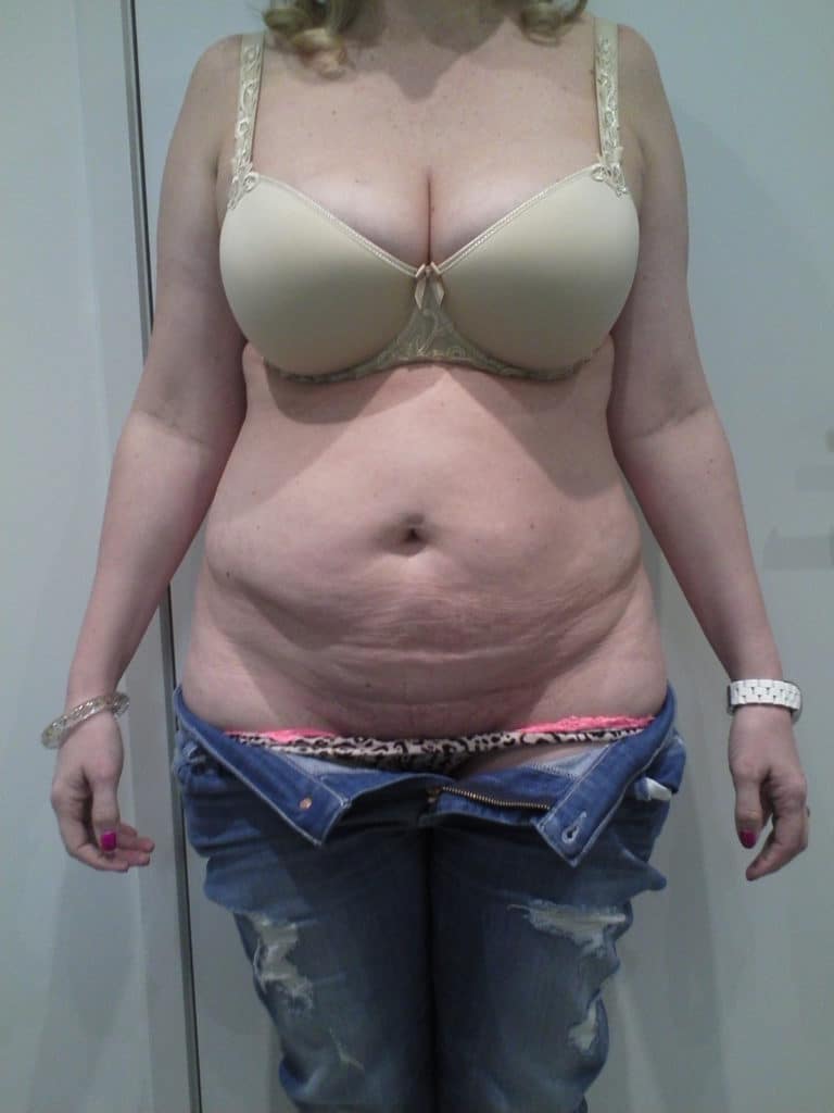 Tummy Tuck Before and After Photos