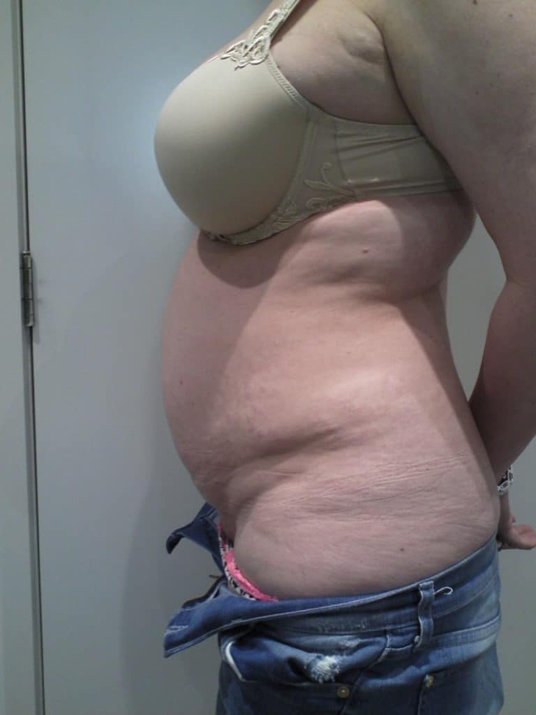 Tummy Tuck Before and After Photos