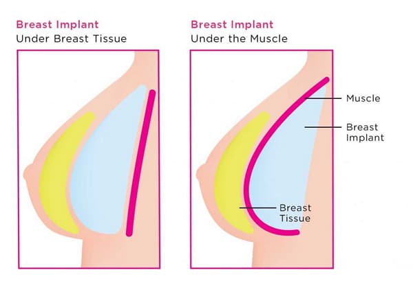 breast implants Auckland - breast-implant-placement-under-muscle breast enhancement surgery options