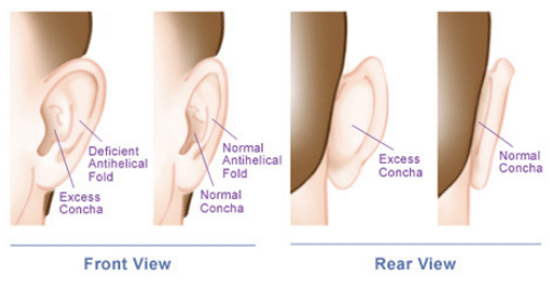 otoplasty ear surgery best ear plastic surgeon NZ for kids