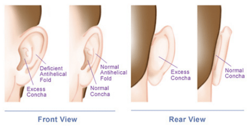 otoplasty ear surgery best ear plastic surgeon NZ Earlobe surgery