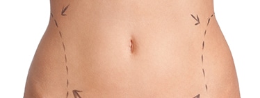 Tummy Tuck Abdominoplasty Auckland