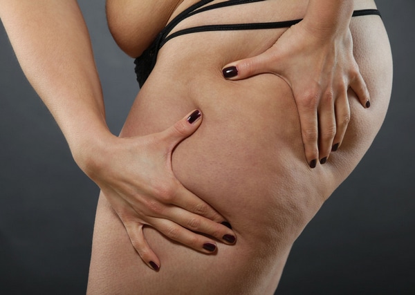cavi lipo auckland - body contours Auckland - liposuction nz - celebrities with lipedema