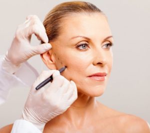 facelift surgery Auckland