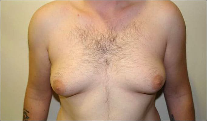 Gynecomastia Surgery - Male Breast Reduction - Gyno Surgery - Man Boobs - Moobs - Dr Mark Gittos - Best Gyno Surgery NZ - Best Gyno Surgeon NZ