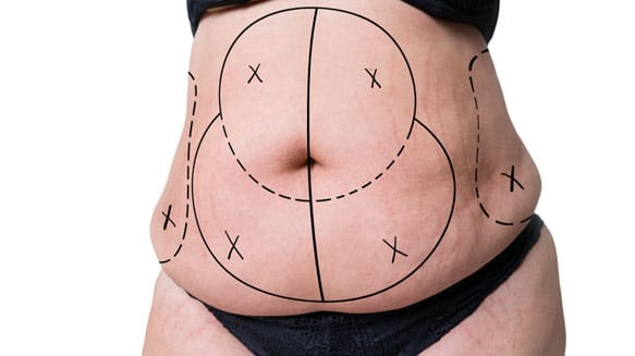 Tummy Tuck Benefits