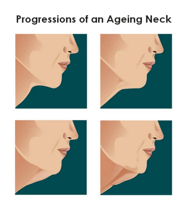 double chin removal NZ - Chin reduction surgery recovery - Neck Surgery Saggy Neck Droopy neck Best Necklift Surgeon NZ