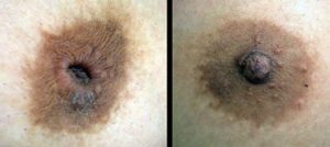 Inverted Nipple Repair - Farber Plastic Surgery