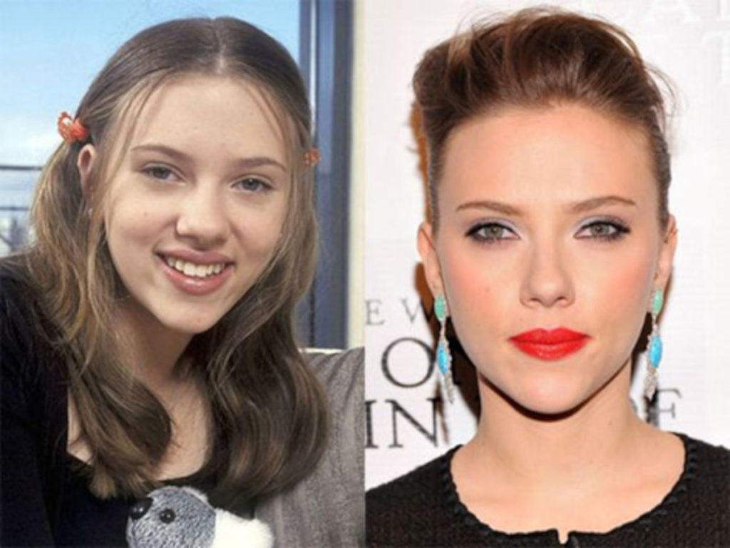 Scarlett Johansson before and after nose job pictures (alarplasty)