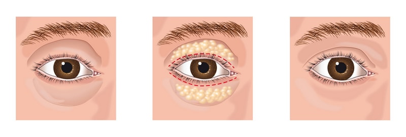 eyelid surgery mistakes