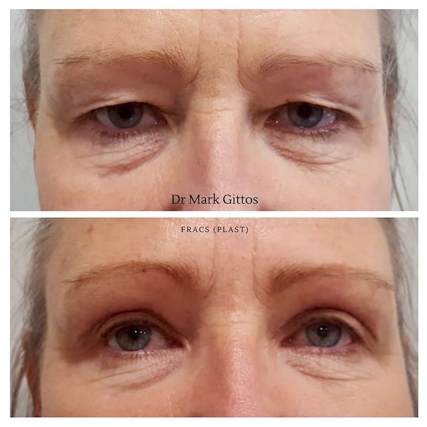 Eyelid Lift Before and After by Dr Mark Gittos NZ Plastic Surgeon