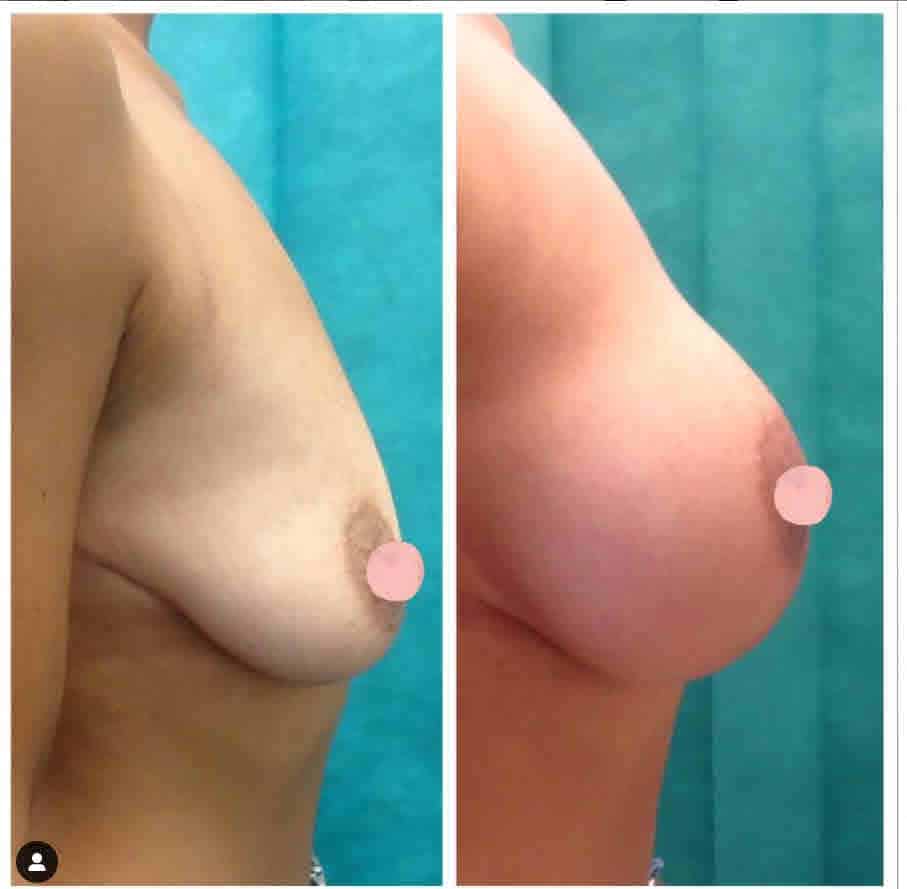 Before-and-After-Breast-Augmentation-for-Ptosis-Side-View-by-Dr-Mark-Gittos-Top-Breast-Surgeon-New-Zealand