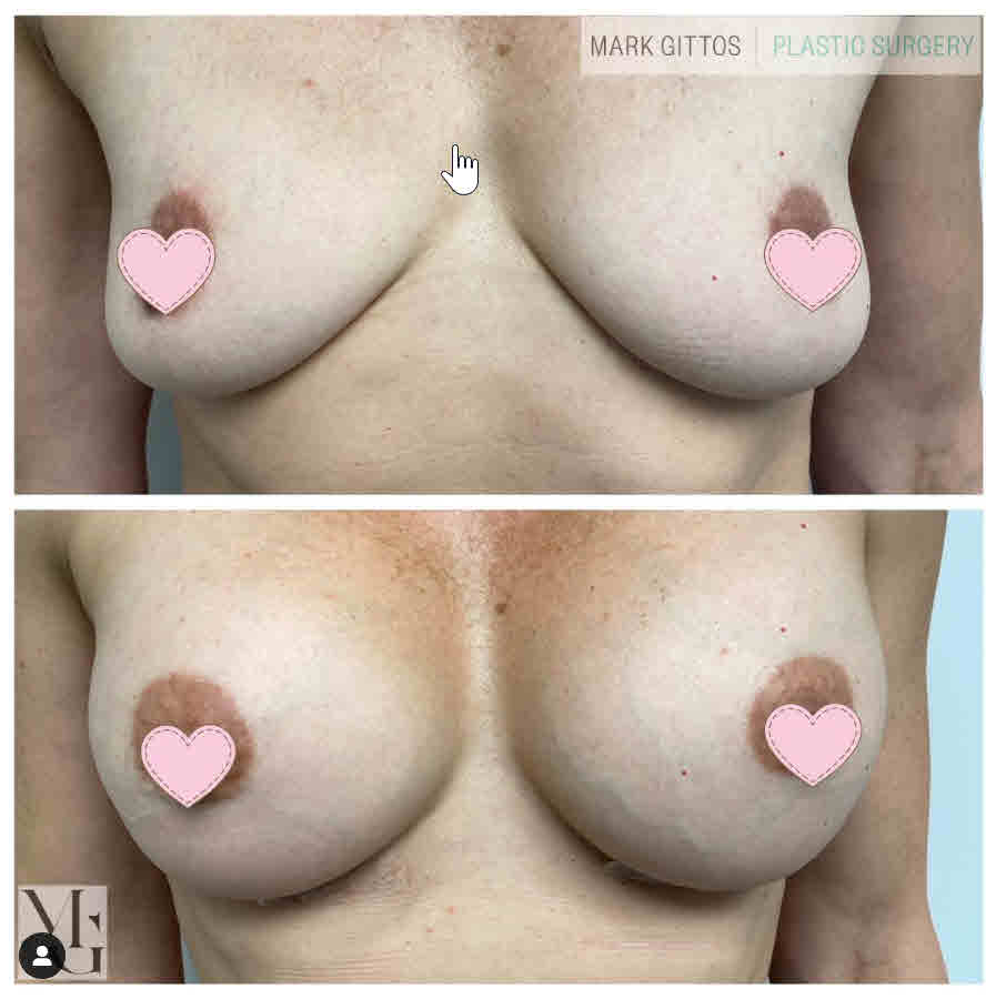 Dr Mark Gittos Breast Augmentation Before and After Photo Motiva Implants