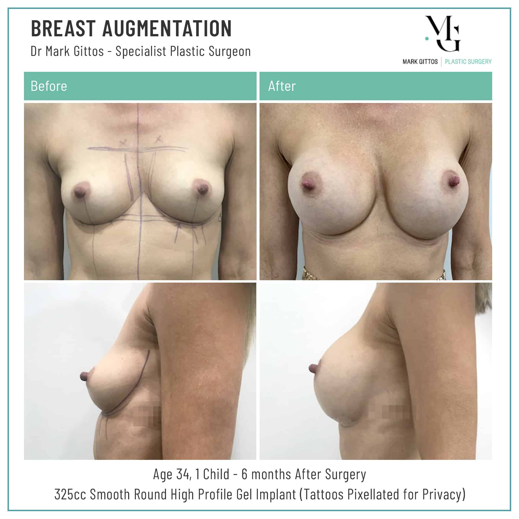 Breast-Augmentation-Before-and-After-5-Dr-Gittos-Blur