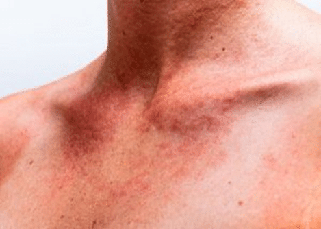 Sun Protection Tips, Good Sunscreens and regular skin checks Image for Reddish Skin in Dr Mark Gittos Blog