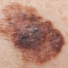 Types of Skin Cancer and Where They Show Up on Your Body Image for Skin Growths in Dr Mark Gittos Blog