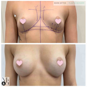 Dr Mark Gittos Breast Augmentation Before and After Photo Gallery Motiva 300cc Round
