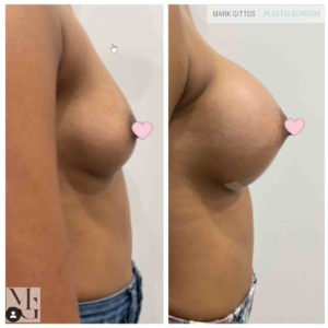Dr Mark Gittos Breast Augmentation Before and After Photo Gallery Motiva 380cc Round