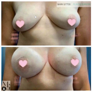 Dr Mark Gittos Breast Augmentation Before and After Photo Gallery Motiva 400 cc Round