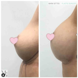 Dr Mark Gittos Breast Augmentation Before and After Photo Gallery Motiva 450cc Round
