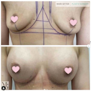 Dr Mark Gittos Breast Augmentation Before and After Photo Gallery Motiva 350 Round High Profile