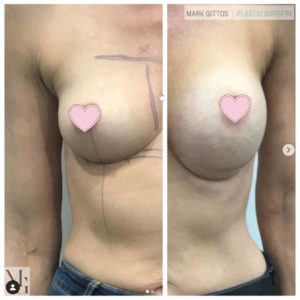 Dr Mark Gittos Breast Augmentation Before and After Photo Gallery Motiva 450 Sub Mammary