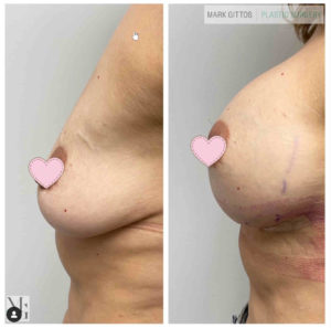 Dr Mark Gittos Breast Augmentation Before and After Photo Gallery Motiva 285cc Round