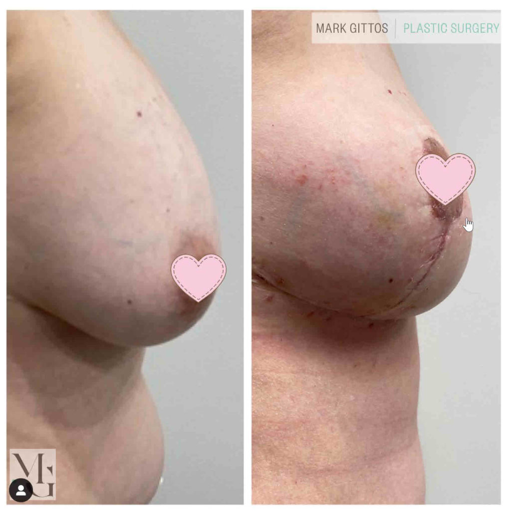 Breast Implant Removal with Lift NZ - Dr Mark Gittos Plastic Surgeon