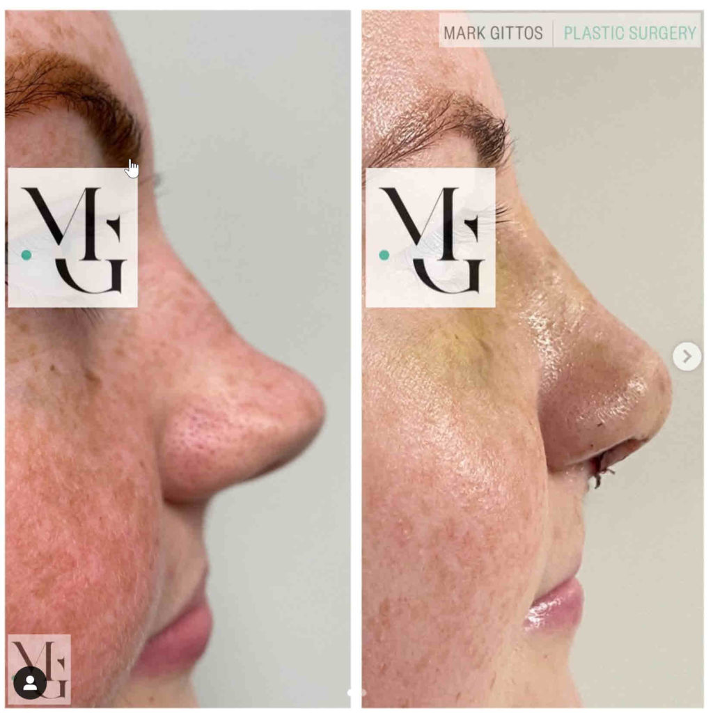 Dr Mark Gittos Rhinoplasty Before and After Photo