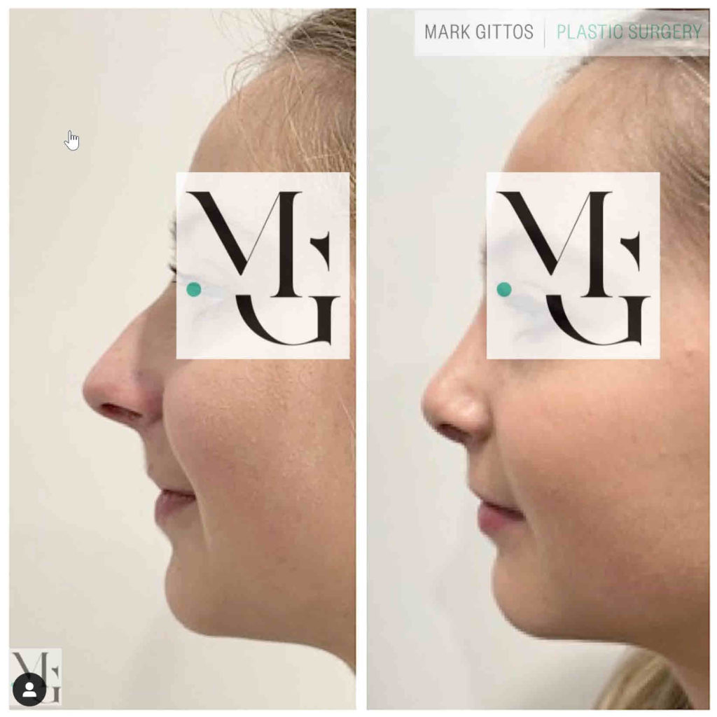 Rhinoplasty Auckland - Nose Job Auckland - Dr Mark Gittos Best Plastic Surgeon NZ Septo Rhinoplasty Before and After Photo