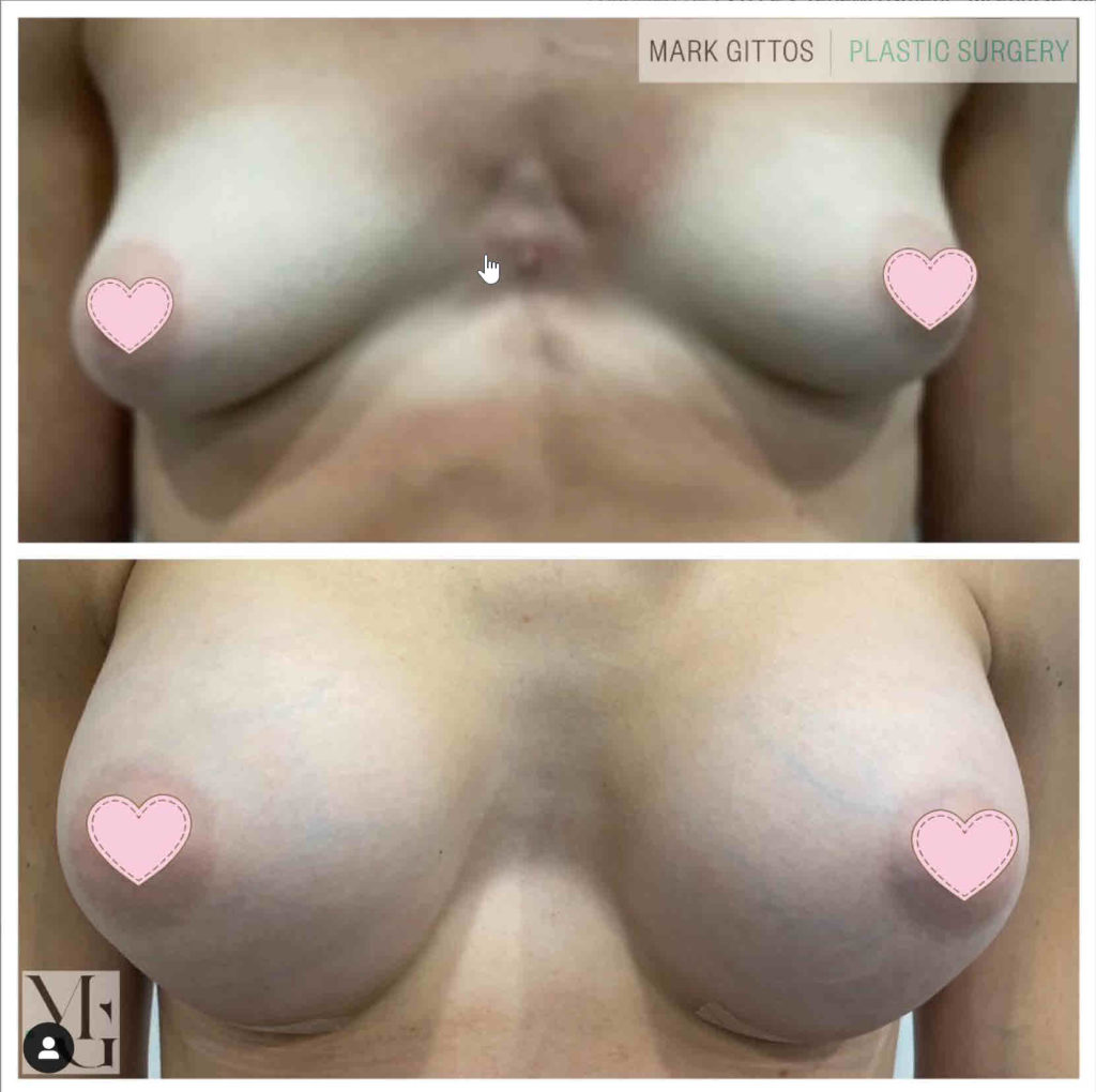 Dr Mark Gittos Tubular Breast Before and After Photo