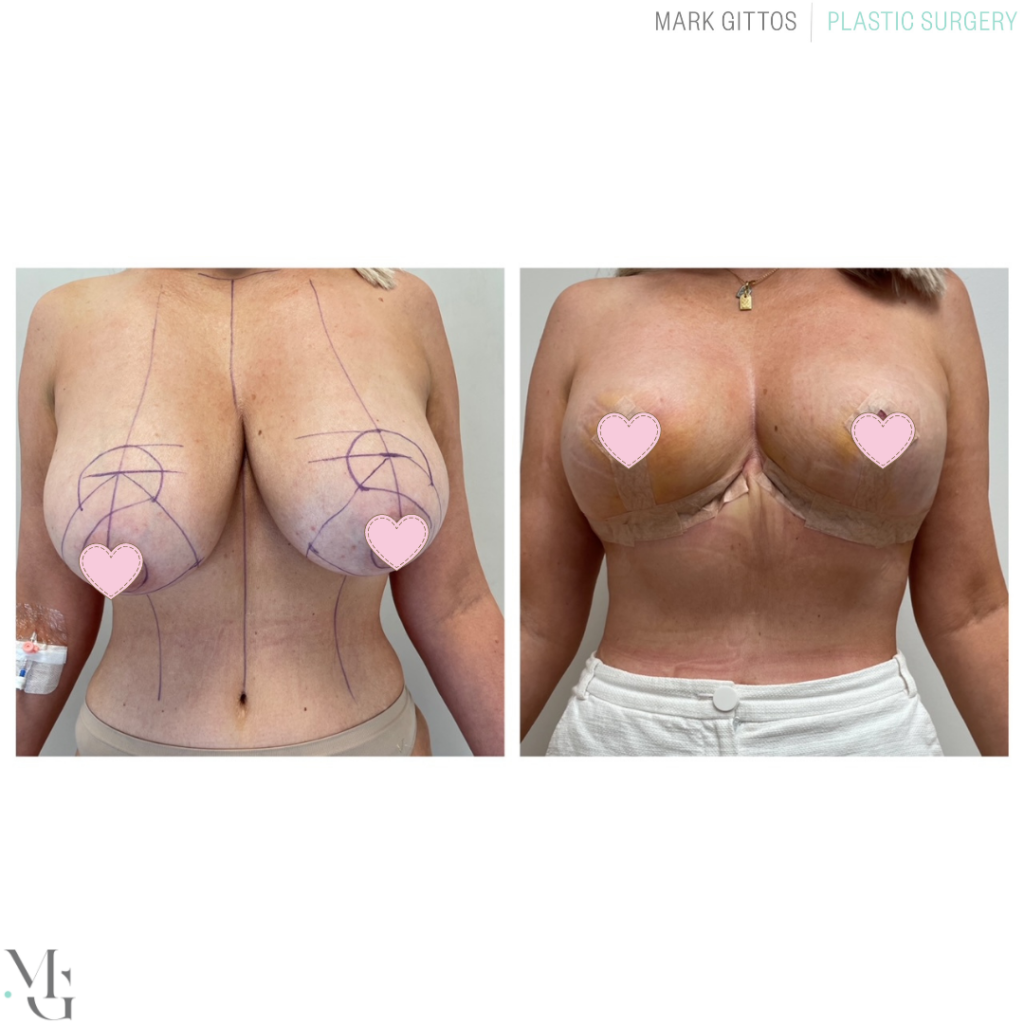 Breast reduction Before and after - Boob Reduction Photos