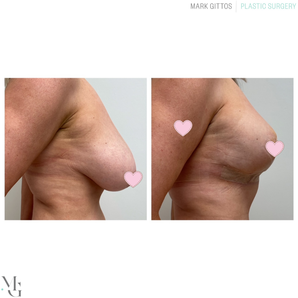 Breast reduction Before and After Photos -Dr Mark Gittos