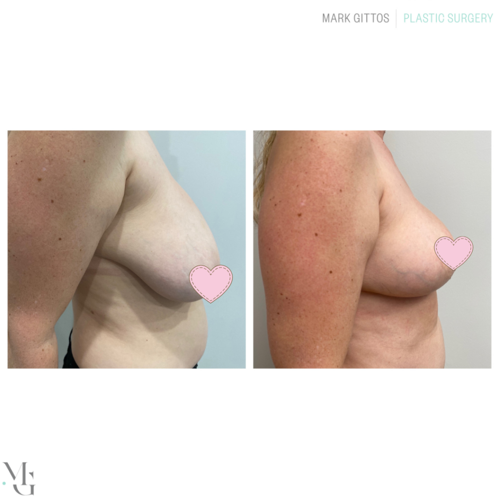 Breast reduction before and After Boob Photos Dr Gittos