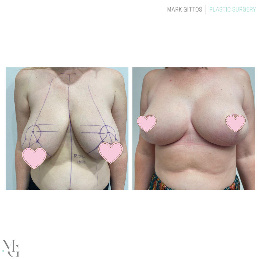 Breast Reduction Before and After