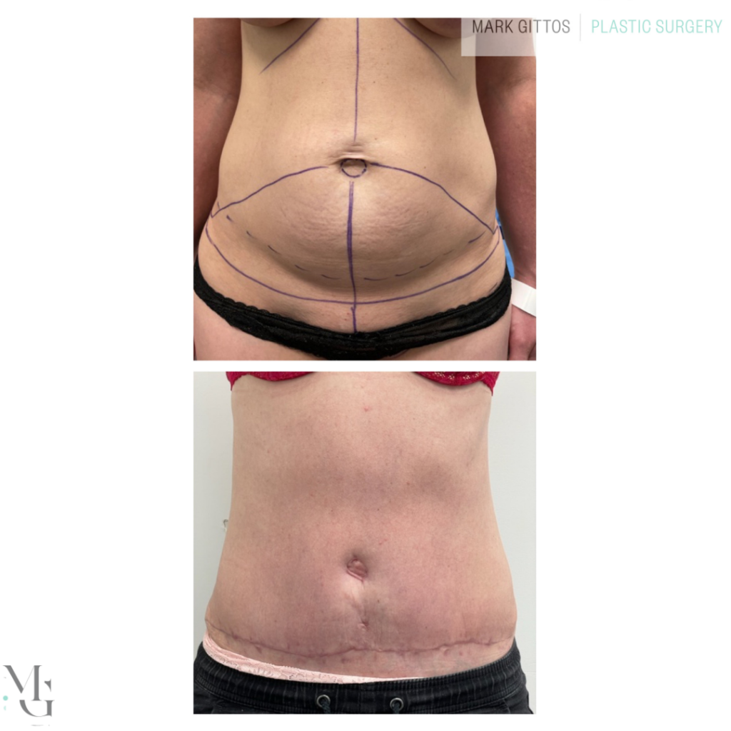 Tummy Tuck Before and After Dr Gittos