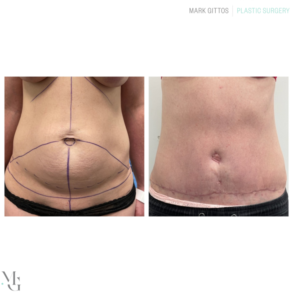 Tummy Tuck Before and After - Abdominoplasty Photos