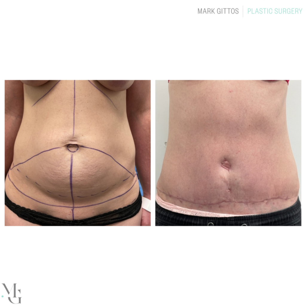 Tummy Tuck Before and After Photos NZ - Dr Mark Gittos Plastic Surgeon