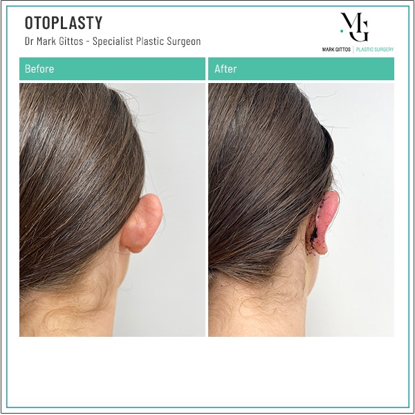 Otoplasty Before and After Dr Mark Gittos Otoplasty Ear Surgery in Auckland NZ New Zealand by Plastic Surgeon